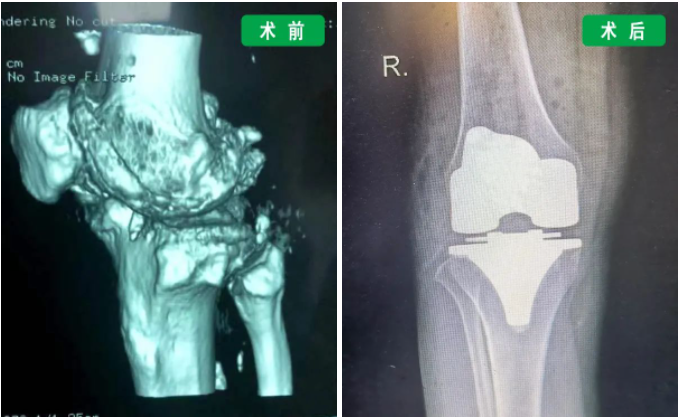 治疗关节终末期疾病的有效方法是……